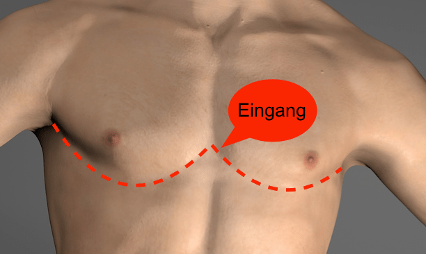 Lebensretter Teil II:&nbsp;Thorakotomie