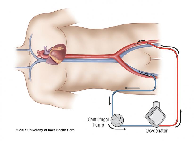 ecmo_3