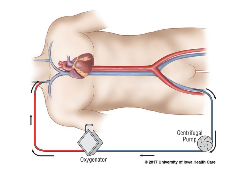 ecmo_5_v2