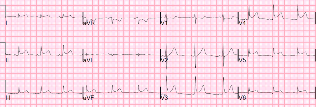 Next day with diffuse ST elevation